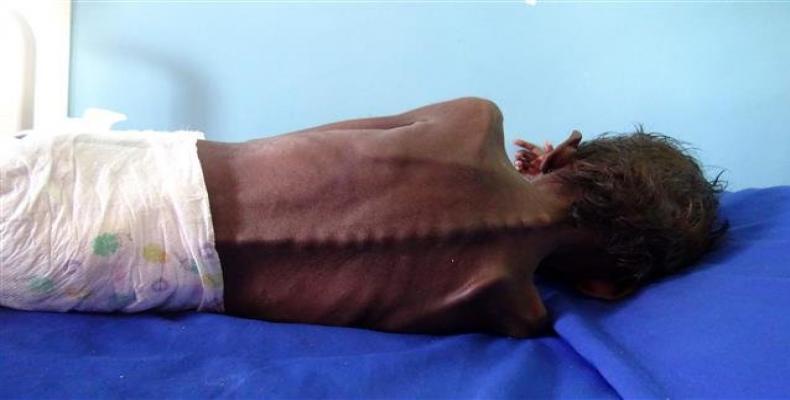 A five-year-old Yemeni boy suffering from severe malnutrition on a bed at a treatment clinic in Khokha district in the western province of Hudaydah, Yemen.  Pho